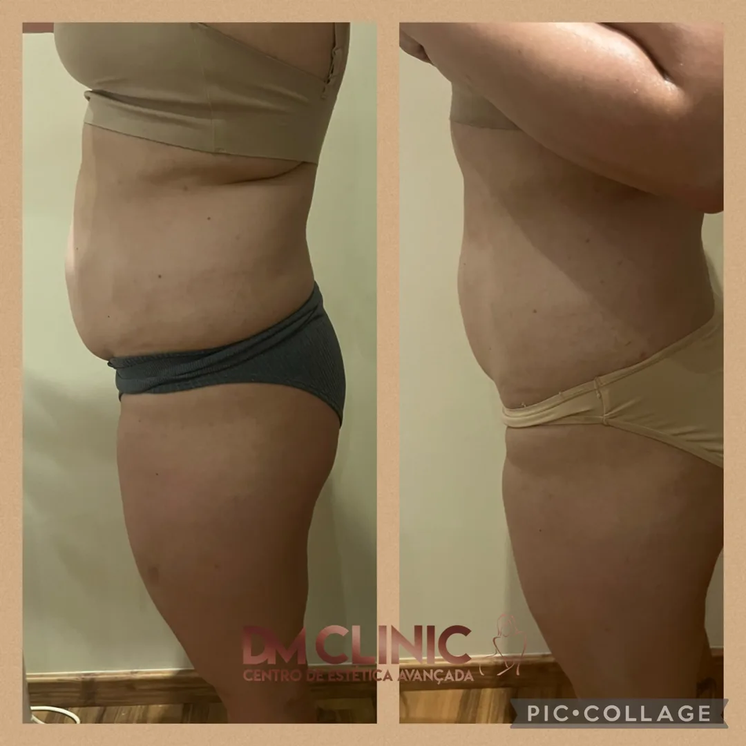 Resultado antes e depois de tratamento na DM Clinic