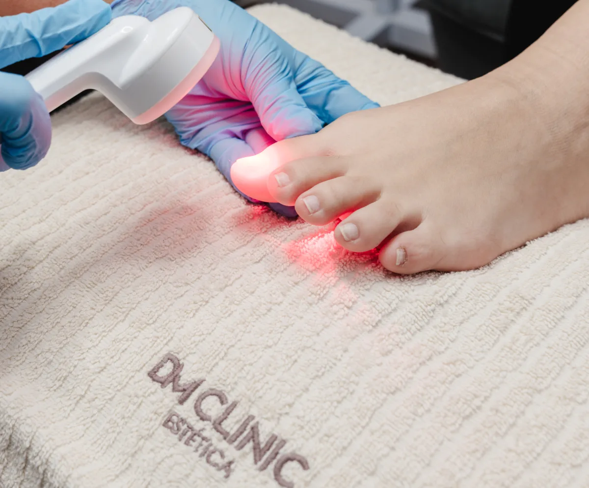 LASER PODOLÓGICO na DM Clinic