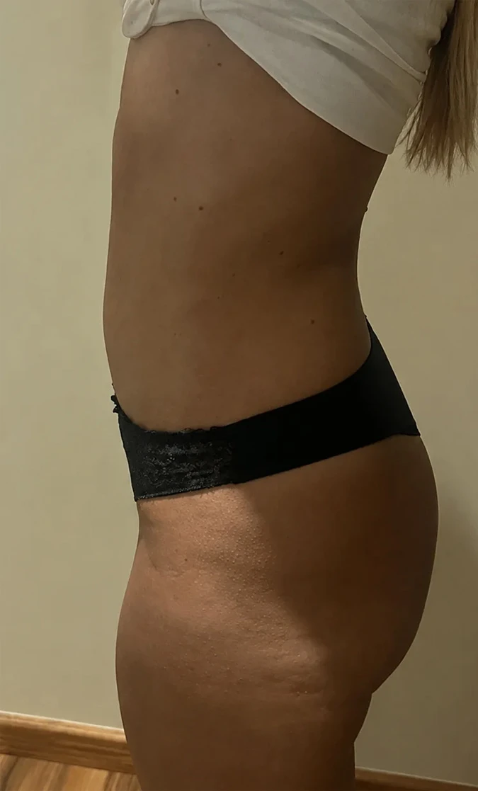 Corpo depois do Método Slim Touch